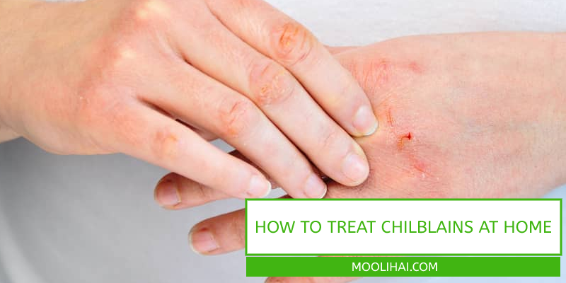 How To Treat Chilblains at Home